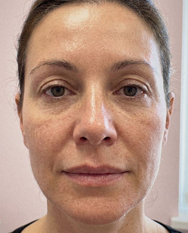 Quanto dura il filler: simulazione del cambiamento dal prima al dopo sulla stessa immagine