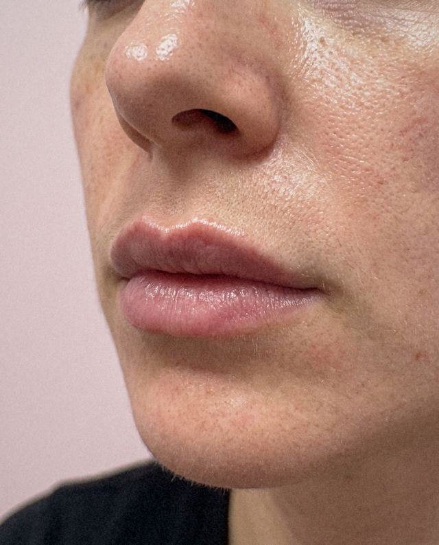 Il filler fa male?: simulazione del cambiamento dal prima al dopo sulla stessa immagine