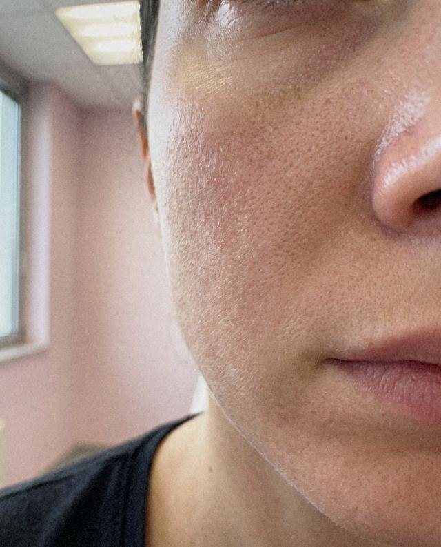 Peeling o microneedling: simulazione del cambiamento dal prima al dopo sulla stessa immagine
