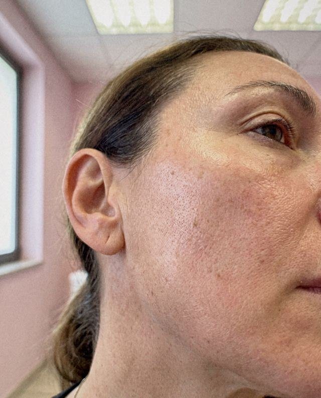 PRP o biostimolazione: simulazione del cambiamento dal prima al dopo sulla stessa immagine