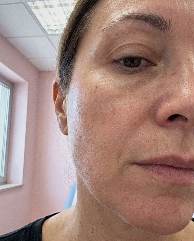 Skinbooster o biorivitalizzazione: simulazione del cambiamento dal prima al dopo sulla stessa immagine